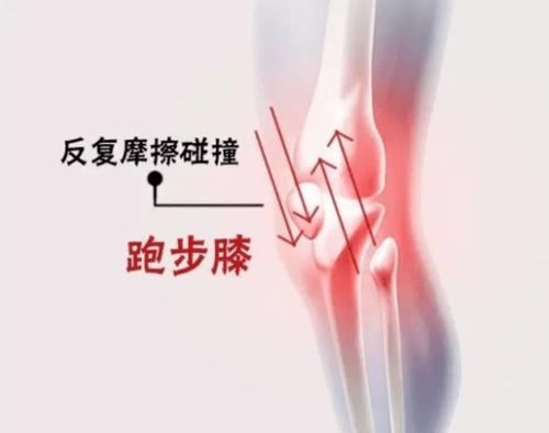 跑步后膝盖疼痛的有效治疗方法