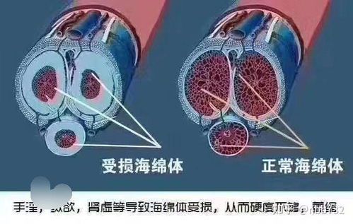 如何科学修复海绵体损伤