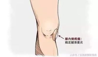 跑步后膝盖内侧疼痛的应对方法