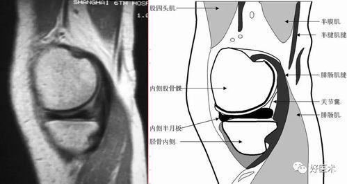 如何判断是否发生半月板损伤