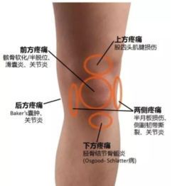 膝盖各部位疼痛详解:症状与可能原因