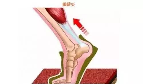 跑步后脚后跟疼痛的常见原因及应对方法
