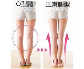O型腿跑步的正确姿势指南