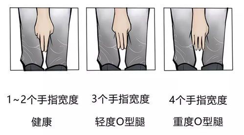 膝盖疼痛时能否继续走路锻炼?科学建议与注意事项