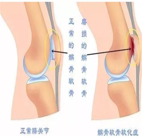 膝盖疼痛的最佳锻炼方法：科学缓解与康复指南